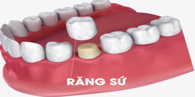 Thông điệp của giấc mơ rụng răng sứ