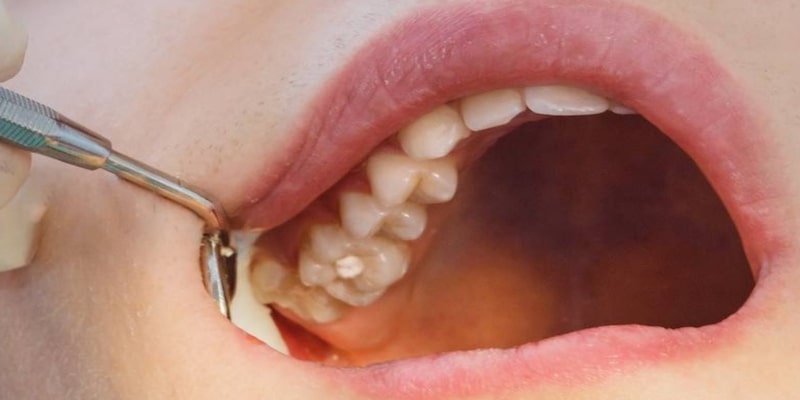 Ý nghĩa của chiêm bao rụng răng hàm trên
